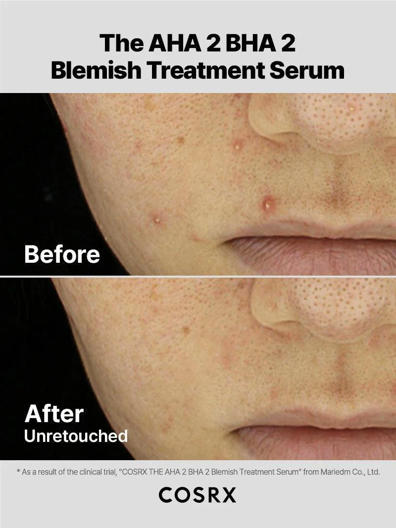 The AHA 2 BHA 2 Blemish Treatment