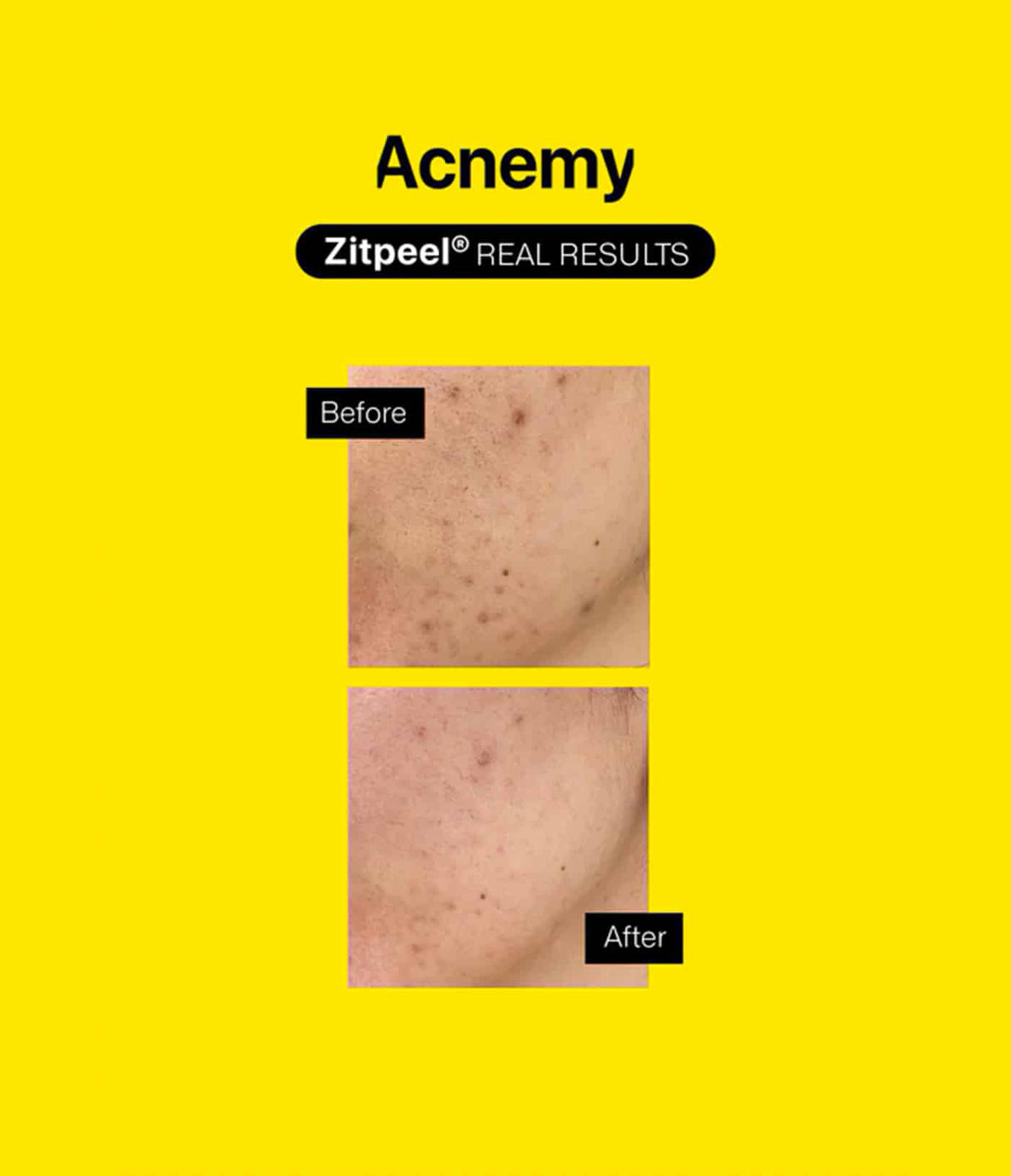 Zitpeel® by Acnemy